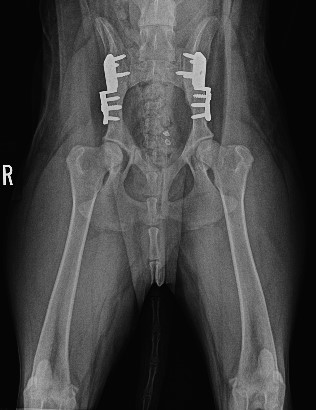 Bilateral Double Pelvic Osteotomy
