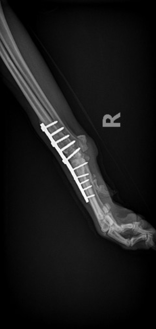 Arthrodesis